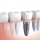 Имплантация зубов - это метод вживления искусственного корня 